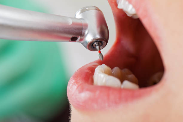 Best Emergency Tooth Extraction in Burlington, CO